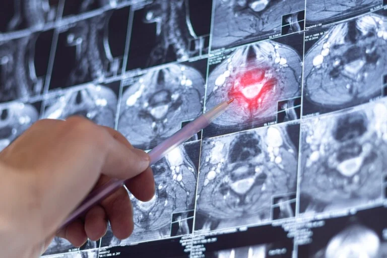 Doctor examining spine MRI - The New Era of MS Care: Treatments and Tools Transforming the ...